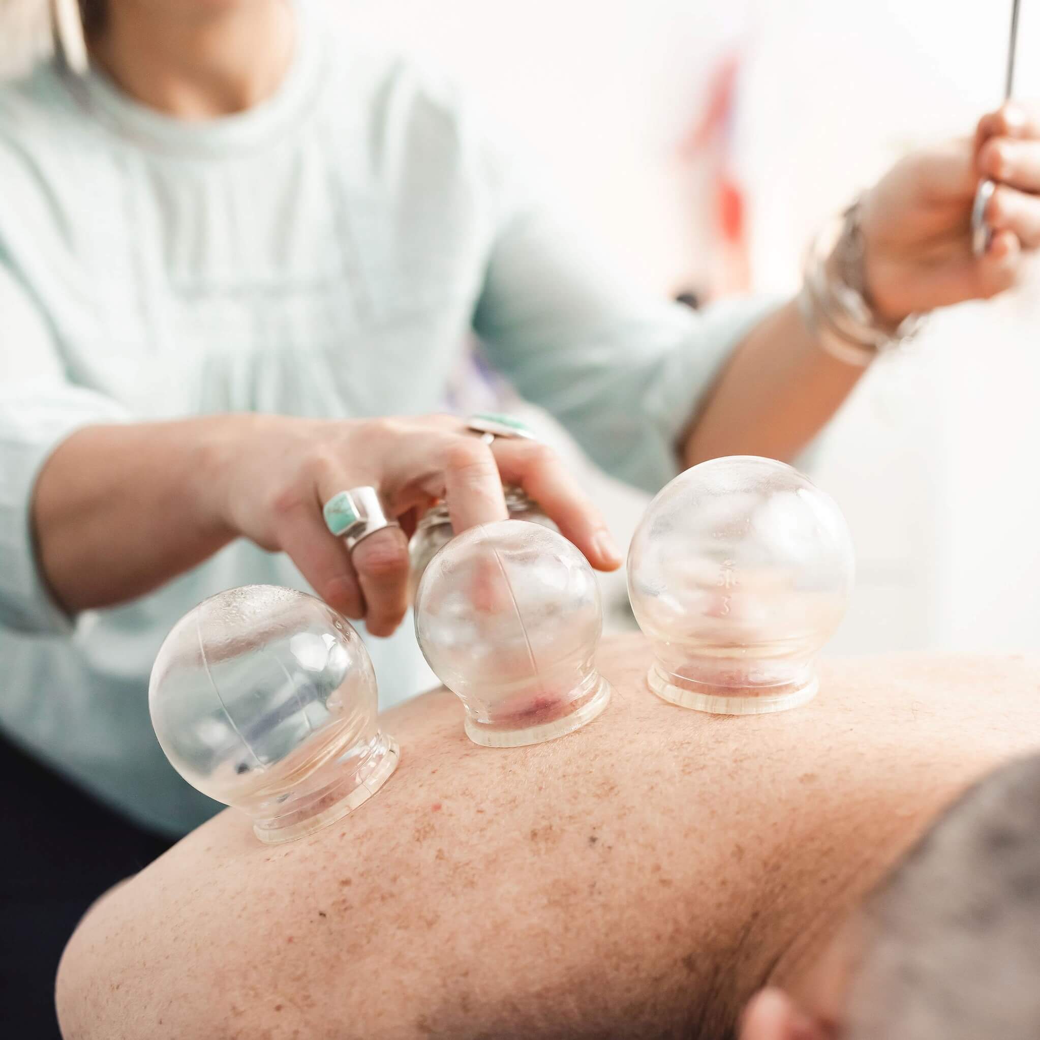 Sunshine Coast Acupuncture offers cupping in Buderim Maroochydore and Forest Glen